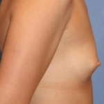 Breast Augmentation Before & After Patient #7261