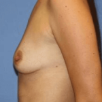 Breast Augmentation Before & After Patient #7253