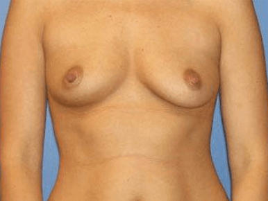 Breast Augmentation Before & After Patient #7255