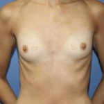 Breast Augmentation Before & After Patient #7257