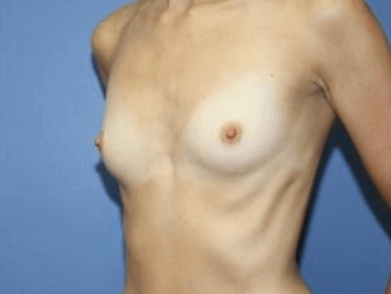 Breast Augmentation Before & After Patient #7195