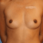 Breast Augmentation Before & After Patient #7194