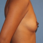 Breast Augmentation Before & After Patient #7249