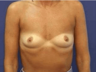 Breast Augmentation Before & After Patient #7246