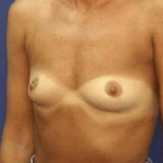 Breast Augmentation Before & After Patient #7245