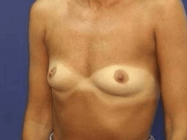 Breast Augmentation Before & After Patient #7245