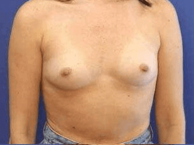 Breast Augmentation Before & After Patient #7247