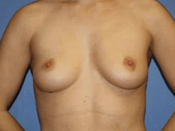 Breast Augmentation Before & After Patient #7193