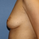 Breast Augmentation Before & After Patient #7191