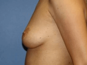 Breast Augmentation Before & After Patient #7193