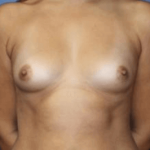 Breast Augmentation Before & After Patient #7190