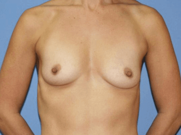Breast Augmentation Before & After Patient #7130