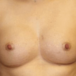 Breast Augmentation Before & After Patient #7103
