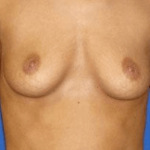 Breast Augmentation Before & After Patient #7184