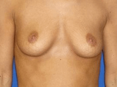 Breast Augmentation Before & After Patient #7184