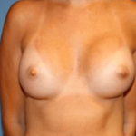Breast Augmentation Before & After Patient #7182