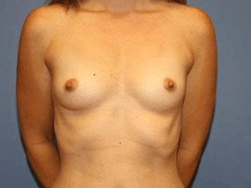 Breast Augmentation Before & After Patient #7138