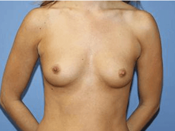 Breast Augmentation Before & After Patient #7180