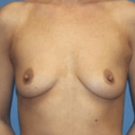 Breast Augmentation Before & After Patient #7132