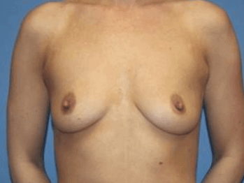 Breast Augmentation Before & After Patient #7132