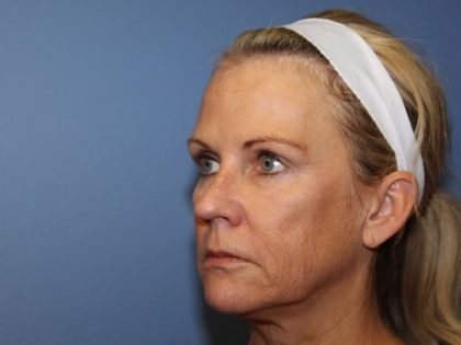 Facelift Before & After Patient #6644