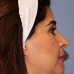 Rhinoplasty Before & After Patient #6710