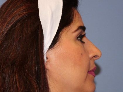 Rhinoplasty Before & After Patient #6710