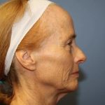 Rhinoplasty Before & After Patient #6709