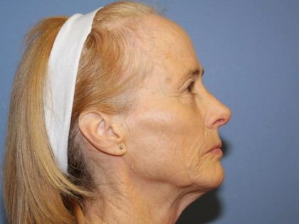 Rhinoplasty Before & After Patient #6709