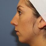 Rhinoplasty Before & After Patient #6581