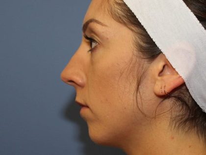 Rhinoplasty Before & After Patient #6581