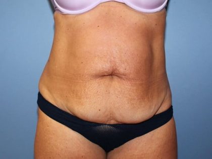 Liposuction Before & After Patient #5873