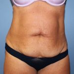 Tummy Tuck Before & After Patient #6531