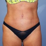 Tummy Tuck Before & After Patient #6531