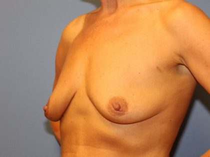 Breast Augmentation + Lift Before & After Patient #7554