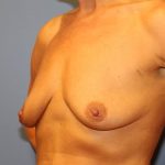 Breast Augmentation + Lift Before & After Patient #7555