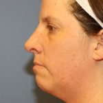 Rhinoplasty Before & After Patient #6708