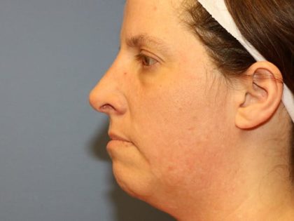 Rhinoplasty Before & After Patient #6708