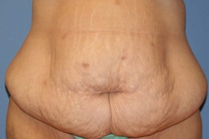 Tummy Tuck Before & After Patient #6530