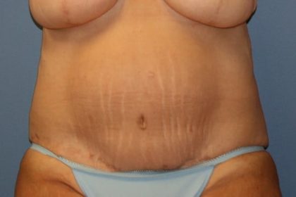 After Weight Loss Surgery Before & After Patient #5783