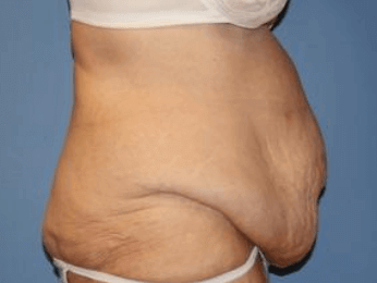After Weight Loss Surgery Before & After Patient #5780
