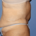 After Weight Loss Surgery Before & After Patient #5780