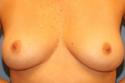 Breast Implant Removal Before & After Patient #7716