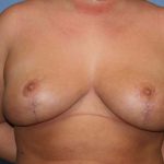 Breast Revision Before & After Patient #7166