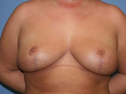 Breast Revision Before & After Patient #7166