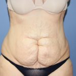 Liposuction Before & After Patient #5874