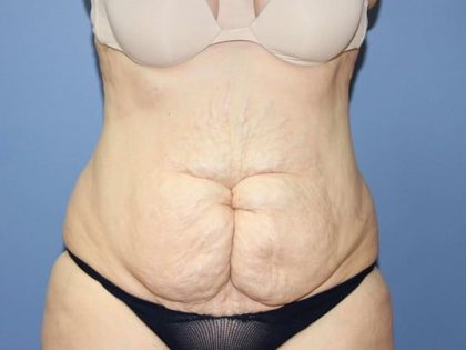 Tummy Tuck Before & After Patient #6433