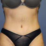 Tummy Tuck Before & After Patient #6433