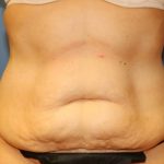 Tummy Tuck Before & After Patient #6436