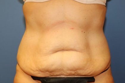 Tummy Tuck Before & After Patient #6436